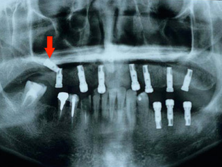 脱落したインプラント症例