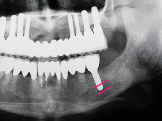 神経を圧迫したインプラント症例