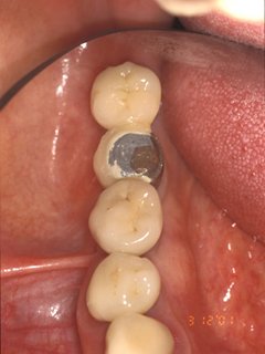 インプラントの白い歯の部分が欠けて金属が露出した症例