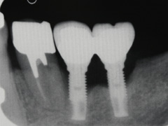 骨が周囲から吸収しているインプラント症例２