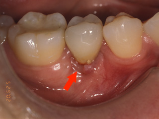 インプラント周囲の歯肉からゴミと膿が出ているインプラント症例