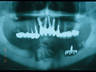 周囲の骨が吸収し除去したインプラント症例
