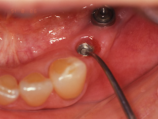 スクリューの破折したインプラント症例