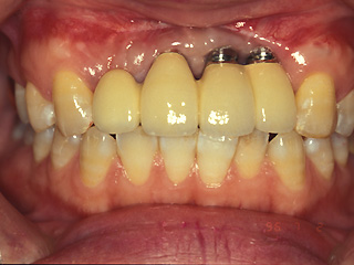 付け根から金属が露出し見た目が悪くなったインプラント症例